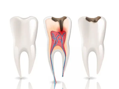Лечение пришеечного кариеса в Москве - цена на лечение пришеечного кариеса  зуба