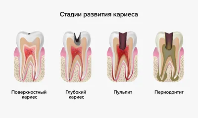 Белый налет на десне после удаления зуба — что означает налет на ране в  лунке после удаления зуба мудрости?