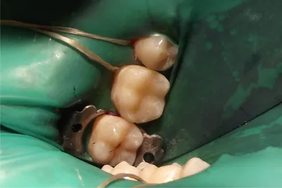 Фиброма десны, губ, щек и слизистых оболочек полости рта: может ли нарост  на нижней и верхней челюстях рассосаться сам – лечение зубов с фото