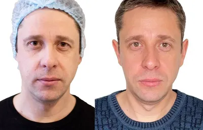 Как сделать худое лицо с помощью филлеров, особенности и преимущества 3Д  моделирования лица