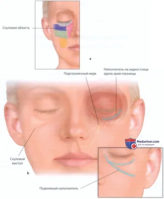 Филлеры для лица: фото до и после процедуры - визуальные трансформации -  Premium Face
