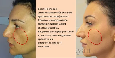 Филлеры в щеки — записаться на контурную пластику щек гиалуроновой кислотой  | Цена | Киев
