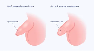 Интимная пластика у мужчин