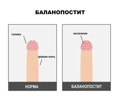 Кольцо сопротивления крайней плоти мужской фимоз для крайней плоти слишком  длинный костюм - купить с доставкой по выгодным ценам в интернет-магазине  OZON (866756617)