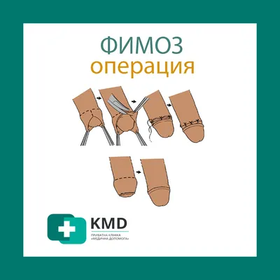 Диагностика и лечение фимоза в Киеве - Цена услуги в клинике CALM