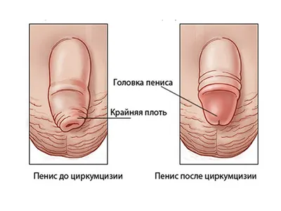 Фимоз у детей: лечение детского фимоза в Одессе | Медицинский дом Odrex