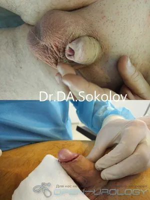 Фимоз у мужчин фото до и после операции фотографии