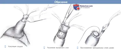 ➡️ Фимоз, симптомы и лечение, причины заболевания у мужчин и женщин -  клиника Девита (Devita)