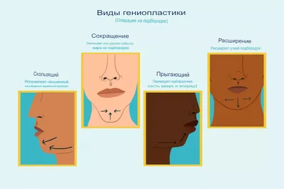 Обрезание / циркумцизия (циркумцизио)