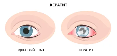 Рожистое воспаление кожи лица
