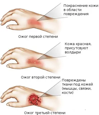 Покраснение и воспаление после пересадки волос - Dr. Acar