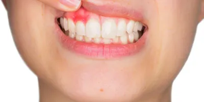 Что такое флюс зуба? | Журнал Startsmile о стоматологии | Дзен