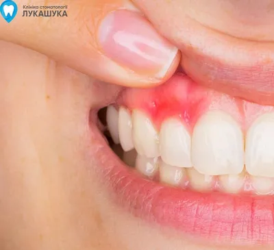 Абсцесс зуба - что такое абсцесс зуба: причины, лечение, симптомы