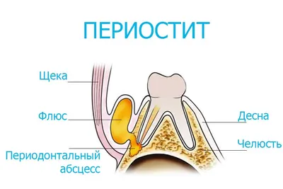 Флюс / шишка / свищ / гнойник 🦷 | Тëтя Фея | Дзен