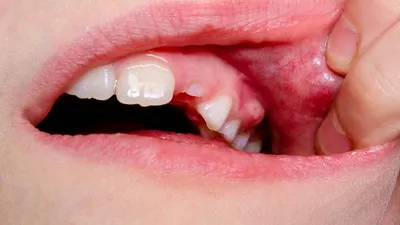 Абсцесс зуба - цены на лечение в Москве, симптомы