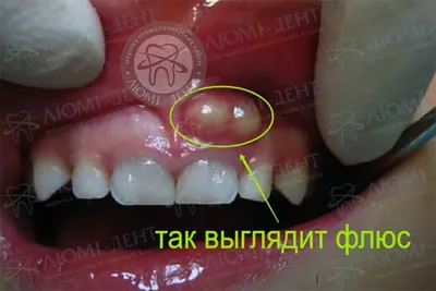 Лечение флюса (периостита): методы лечения, профилактика, цена в Москве