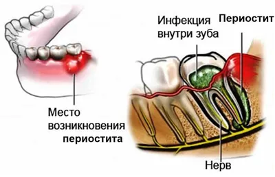 Зубной флюс: причины возникновения, симптомы, лечение