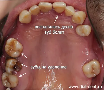 Флюс зуба: причины появления, симптомы заболевания, профилактика и лечение  отека (периостита) на десне в стоматологии