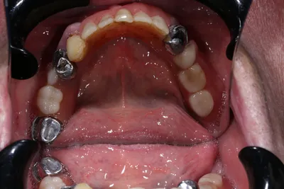 Флюс зуба - диагностика и методы лечения | Стоматология Atlantis Dental