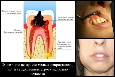 Лечение флюса зубов - цена от 500 ₽ в Санкт-Петербурге | клиника Медикор