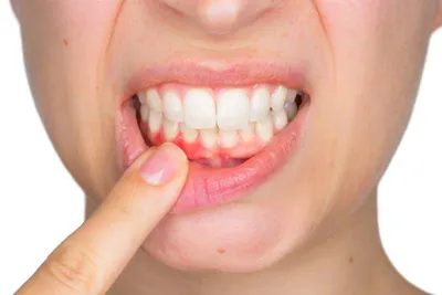 Флюс после удаления зуба: что делать для профилактики | Dental Art