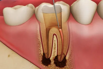 Вылечить зуб из-за воспаления корней не удалось