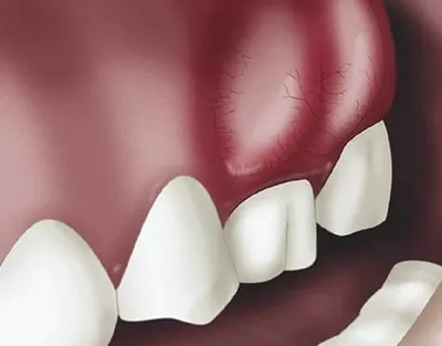 Детская стоматология и ортодонтия в Киеве - блог доктора Пешко Татьяны  Евгеньевны: Флюс у детей - что с этим делать?