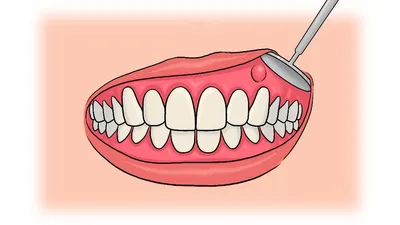 Флюс зуба – что это такое, какие симптомы, как лечить?