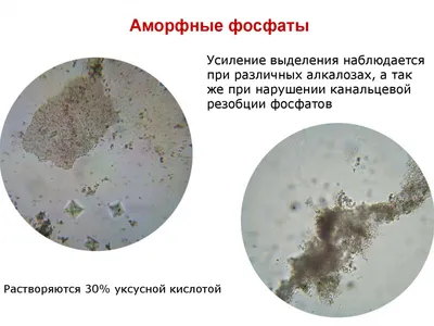 Тройные Кристаллы Фосфата В Моче Человека. Фотография, картинки,  изображения и сток-фотография без роялти. Image 42890179