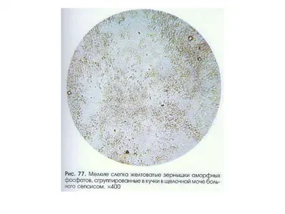 кристалл фосфата кальция в моче Стоковое Изображение - изображение  насчитывающей фосфат, химия: 269084037