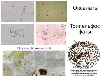 Лаборатория - Осадок мочи. Трипельфосфаты. Почему образуются фосфаты  Основная причина образования конкрементов-трипельфосфатов – нарушение в  организме кислотно-щелочного баланса, характеризующееся повышением щелочной  реакции мочи. Норма кислотности – 5 ...