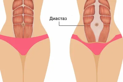 Есть ли у тебя диастаз прямых мышц живота?Простой тест в домашних условиях.  | Здоровая жизнь | Дзен