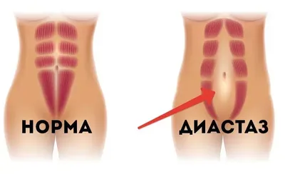 Как убрать диастаз
