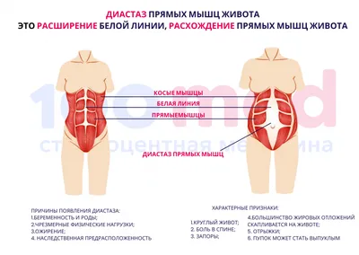 Причины развития диастаза мышц живота | Расхождение мышц живота