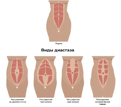 Диастаз прямых мышц живота. Статьи от Академии - ТТ