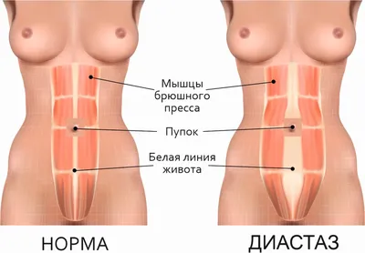 Симптомы и особенности диастаза мышц живота - Исамутдинова Г. М.