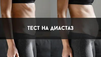 Gerasimova Anna - Абдоминопластика. Ушивание диастаза... | Facebook