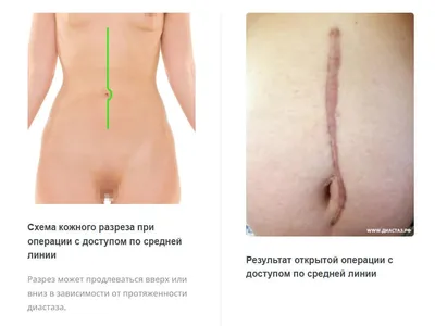 Абдоминопластика, ушивание диастаза прямых мышц живота, операция — в VIP  Clinic, цены в Москве. Операция по устранению диастаза, пластика белой  линии живота, передней стенки живота у мужчин, у женщин после родов.  Стоимость