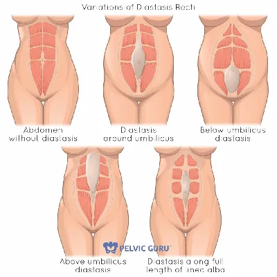 Диастаз: лечение, симптомы, причины, диагностика, последствия, виды и  профилактика заболевания