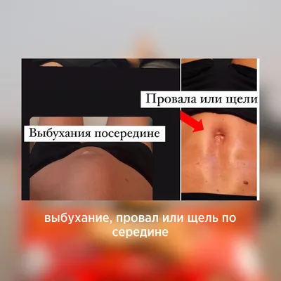 Диастаз - почему развивается, как проявляется и как его убрать в Major  Beauty