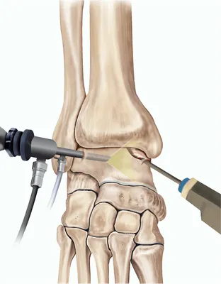 Показания к артроскопии на голеностопе, преимущества артроскопии