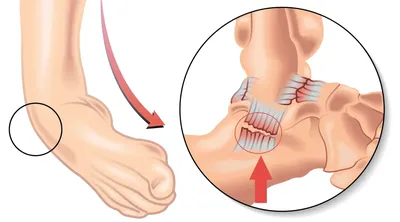 Вывих голеностопа: как быстро вернуть подвижность и забыть о боли