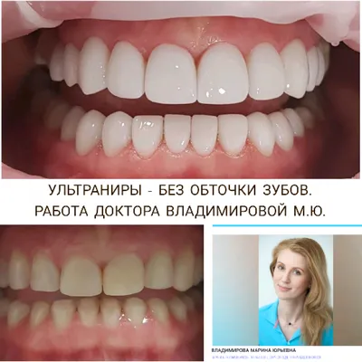 Голливудские виниры, люминиры