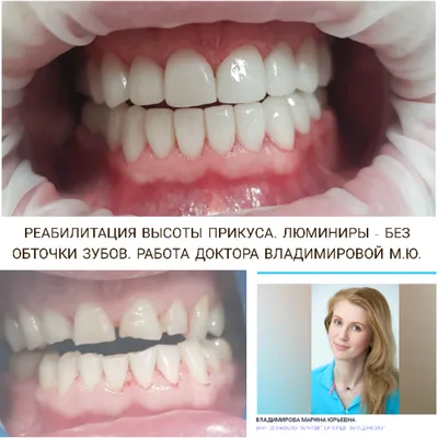 Голливудские виниры, люминиры