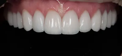 Hollywood Smile – «Голливудская Улыбка» (Коррекция Улыбки) в Анталии, Турция