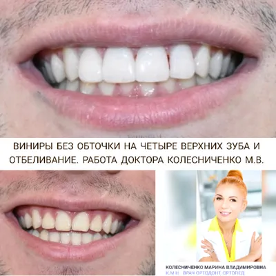 Россиянам рассказали, сколько стоит сделать «голливудскую улыбку» -  Газета.Ru | Новости