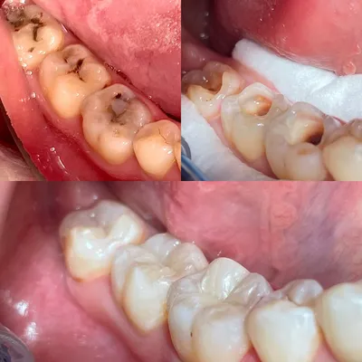 Лечение кариеса в стоматологической клинике \"Доктор Про\"