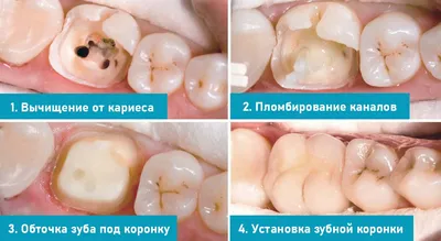 Вторичный кариес - Терапевтическая стоматология - «Аксиома Дентал»