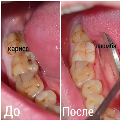 Фотографии лечения глубокого кариеса