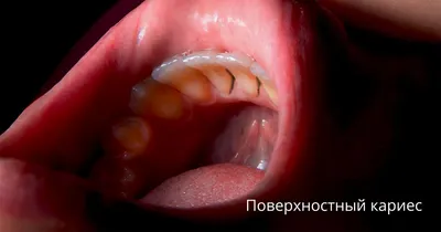 Лечение кариеса | Стоматология в Запорожье Dental Studio